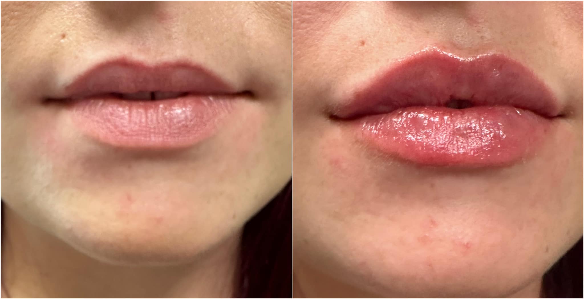 Woman's lips are fuller after injection at Contour Oklahoma in Edmond