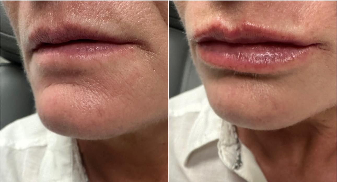 Wrinkle reduction around mouth and lips from injectable treatment at Contour Oklahoma.