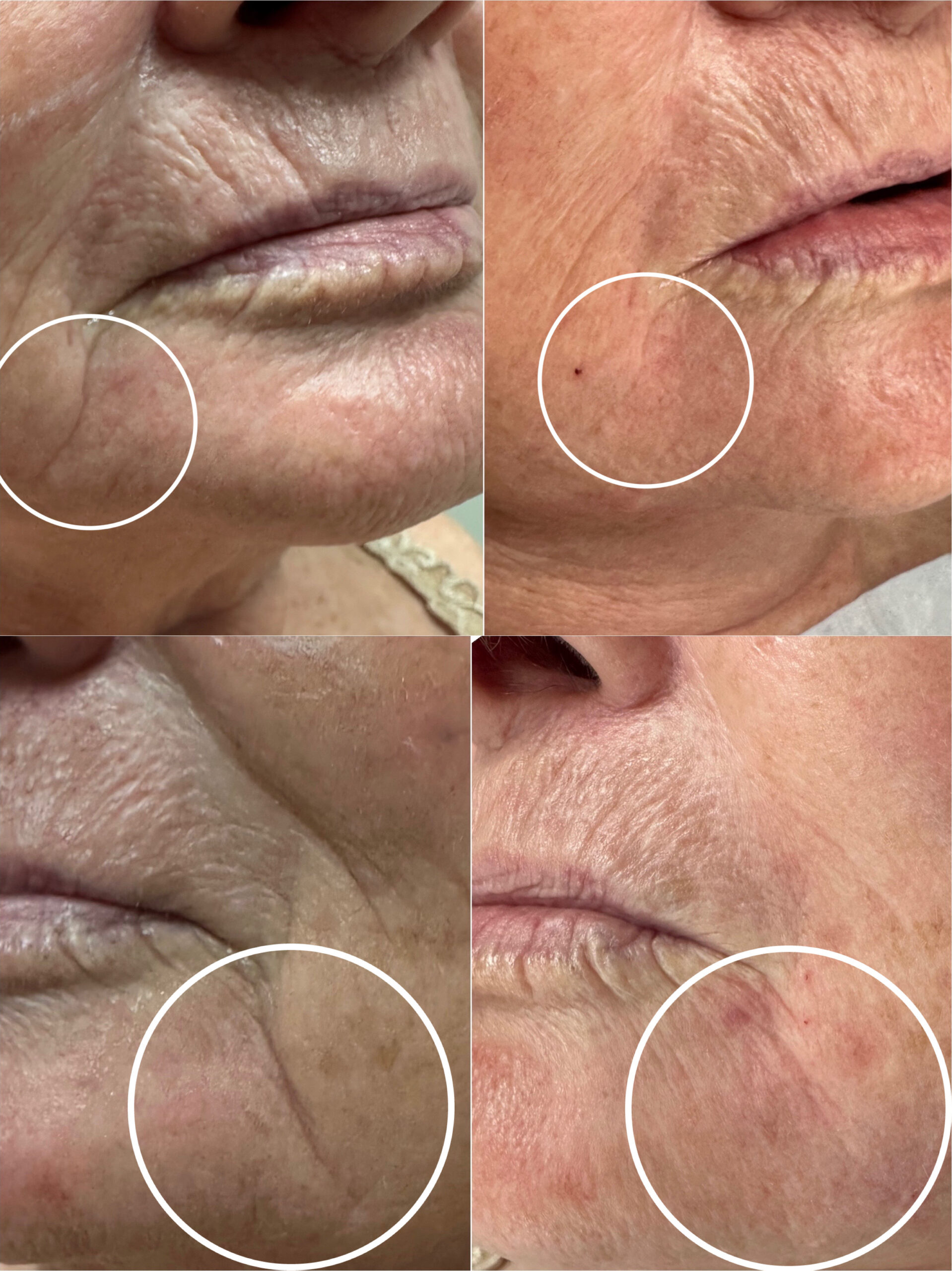 Before and after facial lines improved on woman after treatment with injectables.