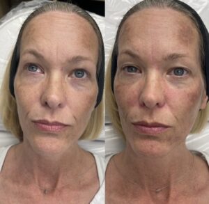 Before and after IPL treatment at Contour Oklahoma.