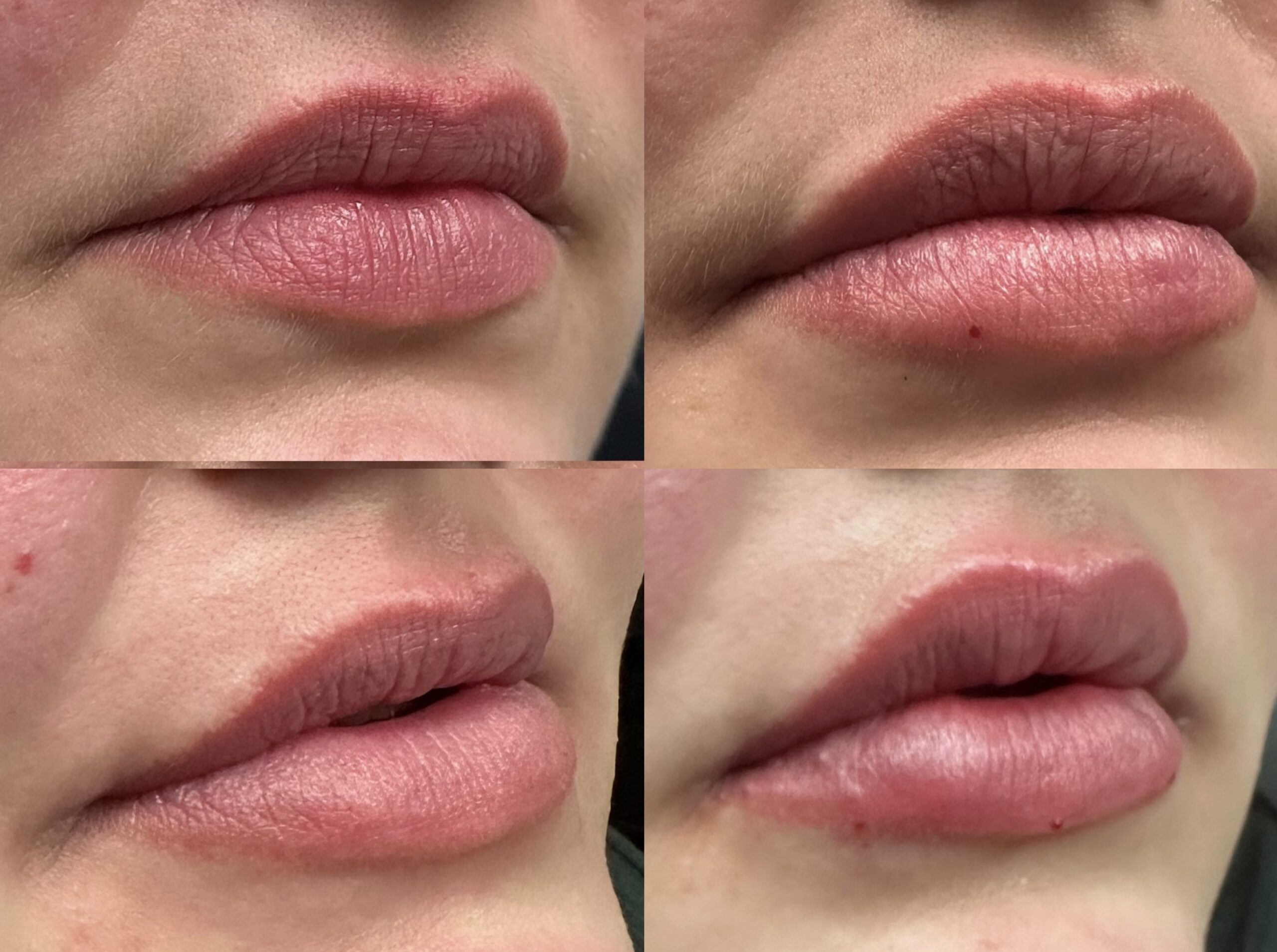 Injectables results from Countour Oklahoma.