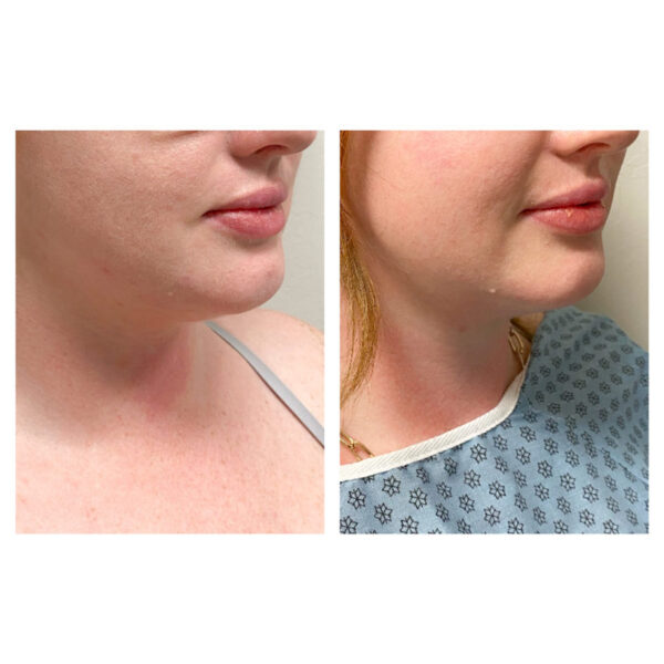 Before and after injectable treatment shows woman's face with tightened skin.