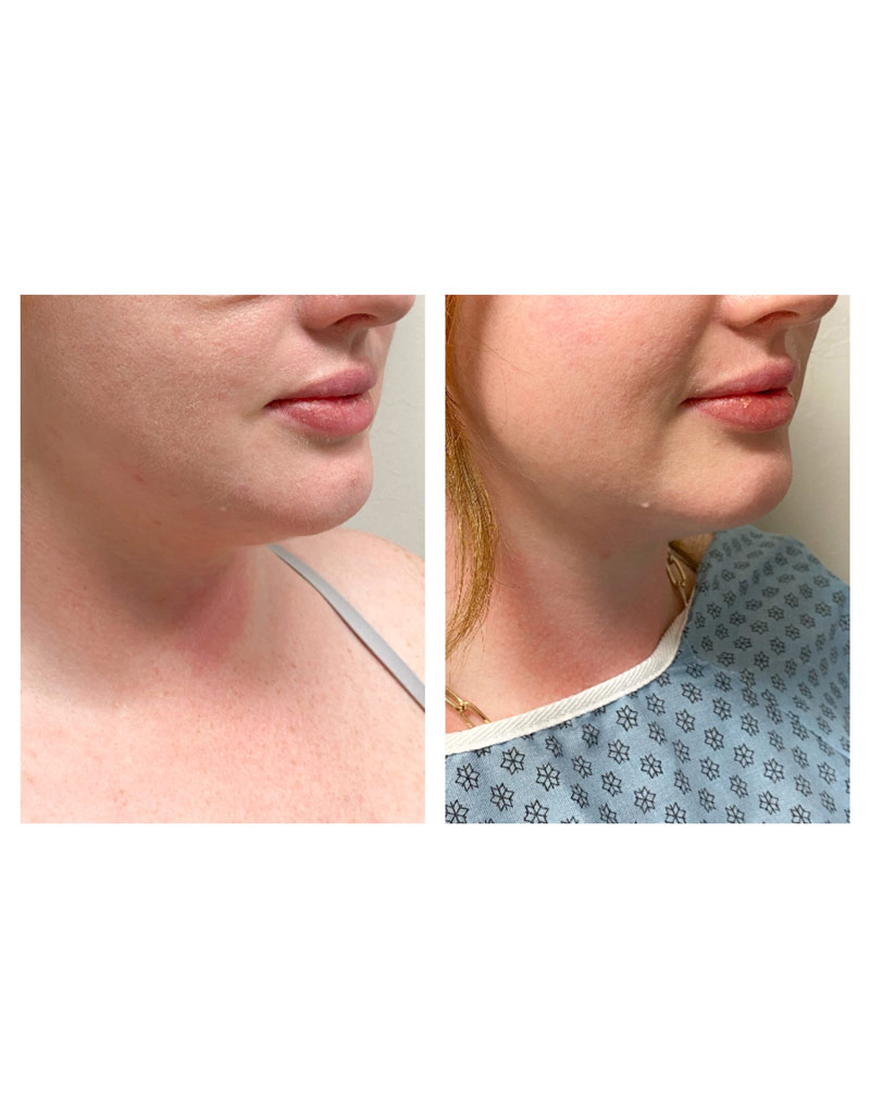 Before and after injectable treatment shows woman's face with tightened skin.