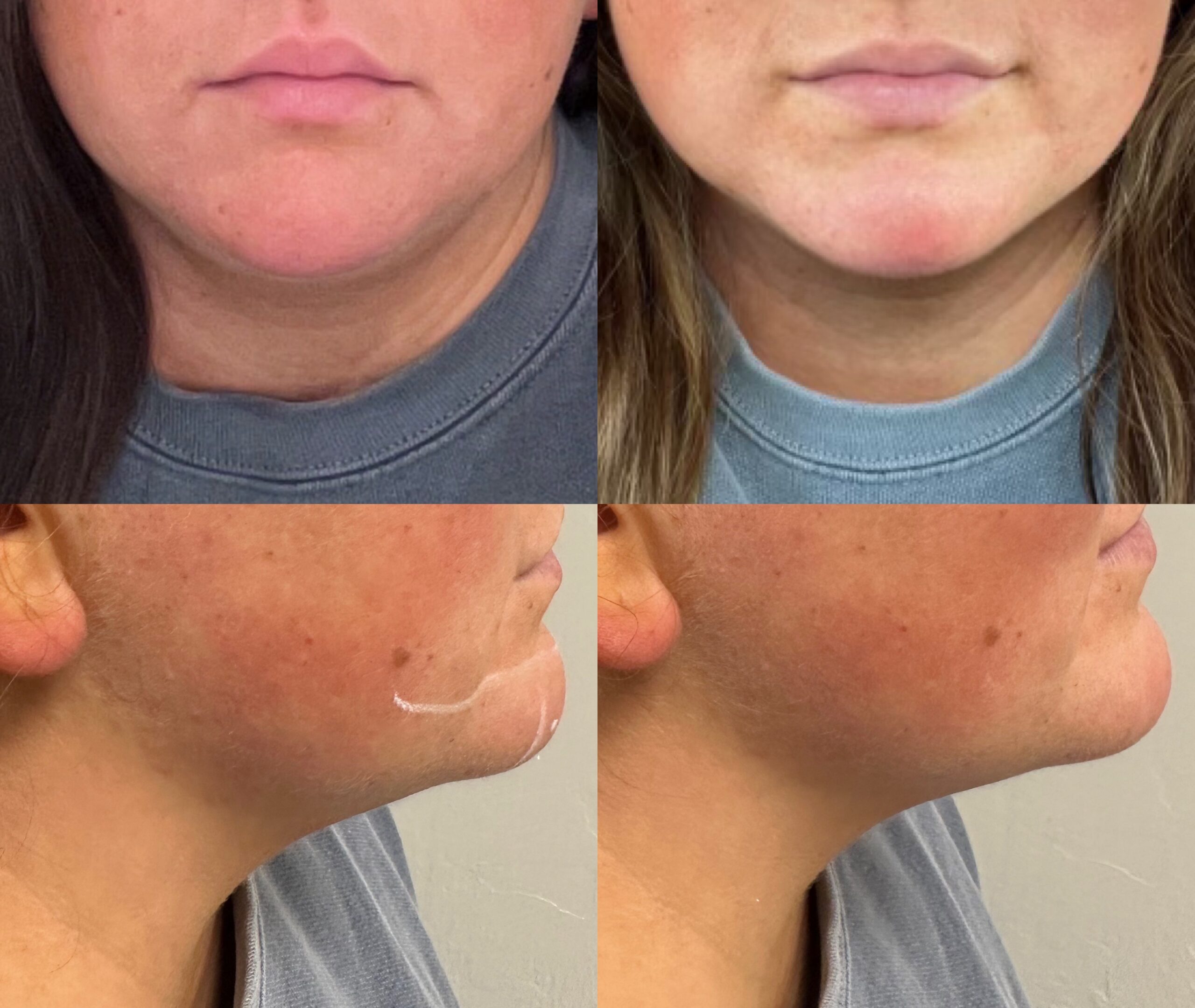 Before and after injectables treatment at Contour Oklahoma shown on woman's face around the mouth and chin area.
