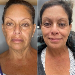 A woman's before and after progress of skin smoothing from IPL treatment at Contour Oklahoma.