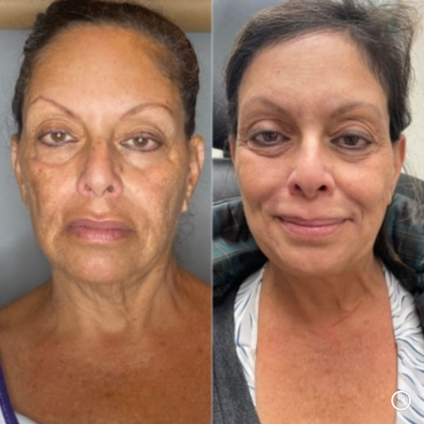 A woman's before and after progress of skin smoothing from IPL treatment at Contour Oklahoma.
