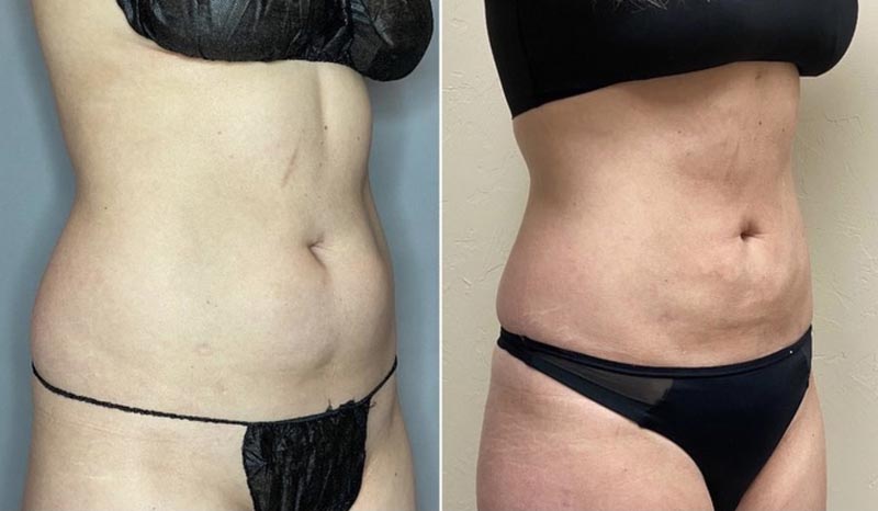 BodyTite procedure results on female patient.