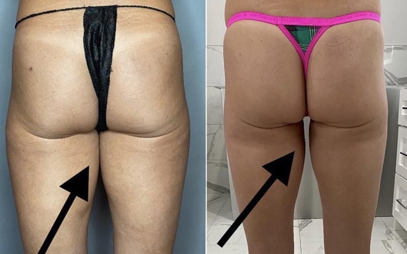 BodyTite results on female patient's thighs - back angle.