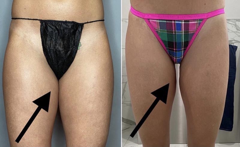BodyTite results on female patient's thighs - front angle.