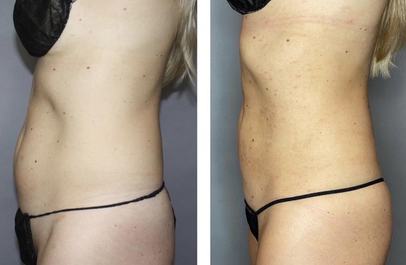 Side view of BodyTite transformation on a female.