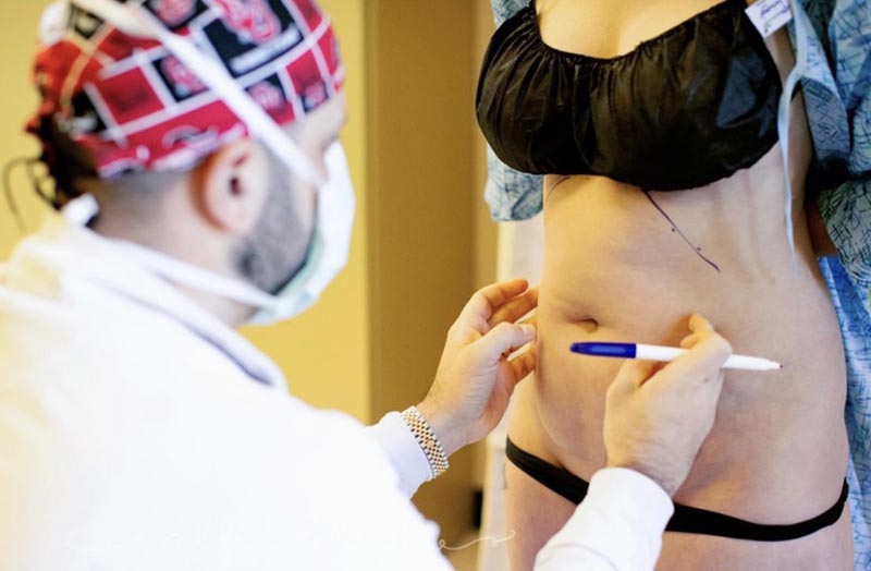 Dr. Shadid preps a female patient for BodyTite procedure.