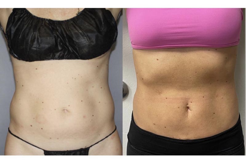 Before and after results of BodyTite on woman's torso.