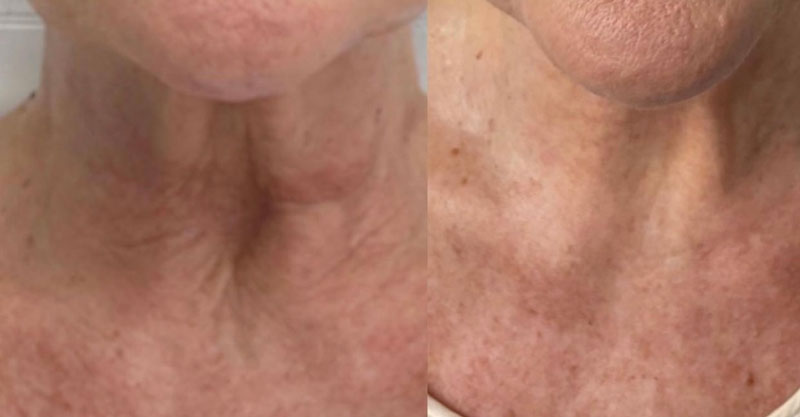 Morpheus8 before and after showing off tightened neck skin.
