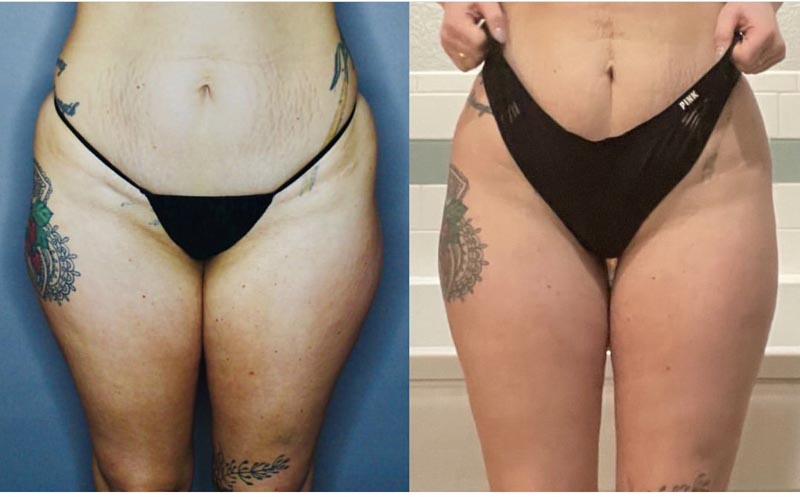 Alternate before/after view of BodyTite procedure shown on woman's bikini line.