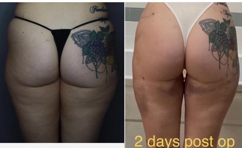 Back side of woman before and after procedure known as BodyTite.