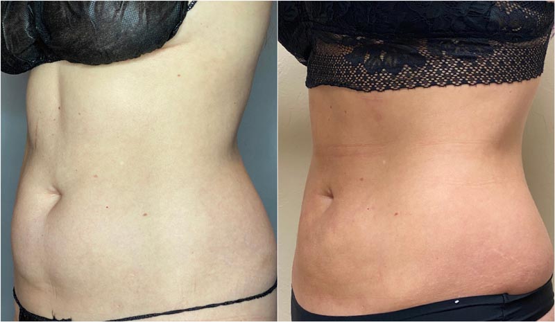 Closer tummy view of female patient's results before and after BodyTite.