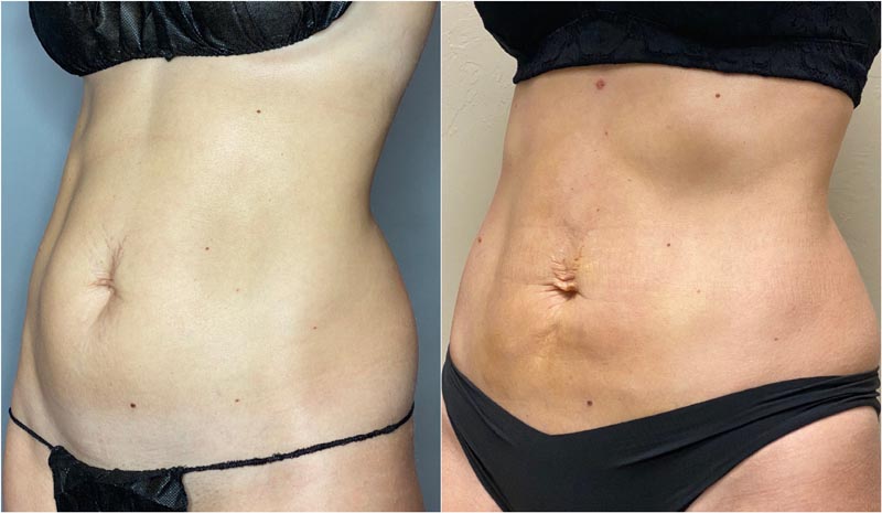 BodyTite transformation of woman in black bikini's torso.