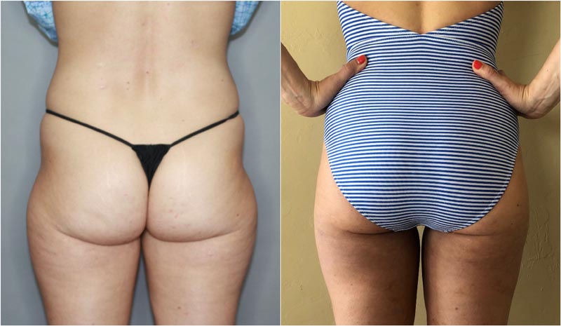 Woman in striped swimsuit shows off backside from BodyTite results.