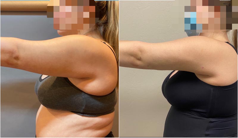 BodyTite transformation before and after picture of blond woman.