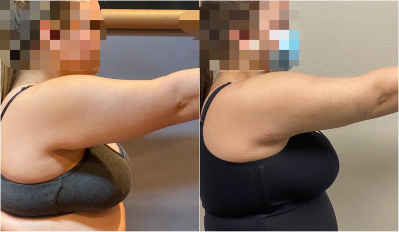 Alternate view of blond woman's BodyTite results.
