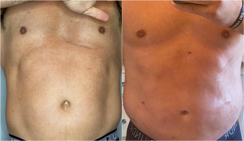 Man's torso before and after successful BodyTite transformation procedure at Contour Oklahoma.