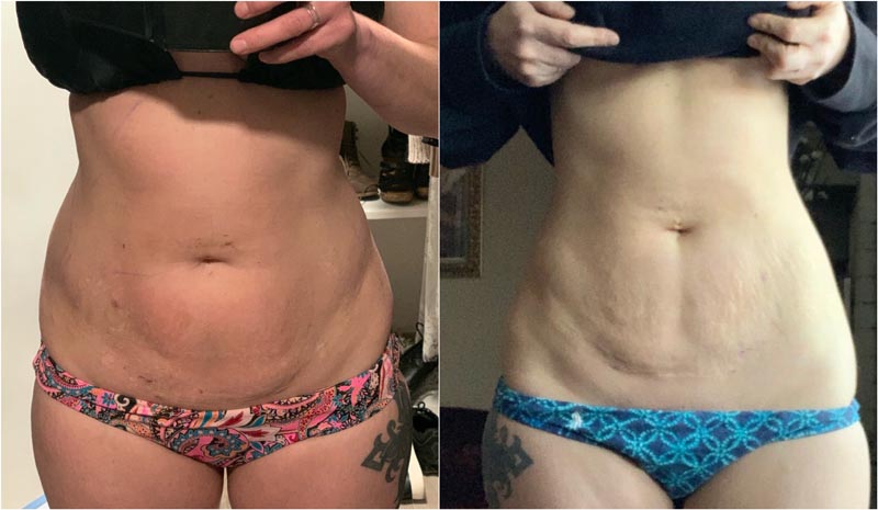 Front view of woman's bikini line before and after BodyTite.