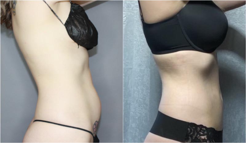 BodyTite before and after results from Contour Oklahoma in Edmond.