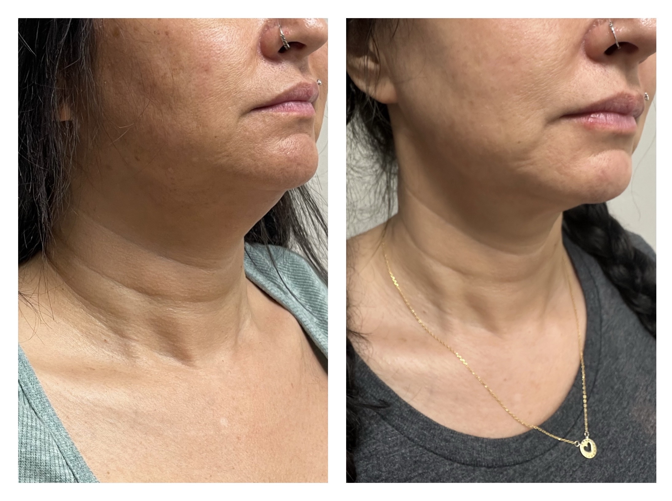 FaceTite procedure from Contour Oklahoma before and after on female.