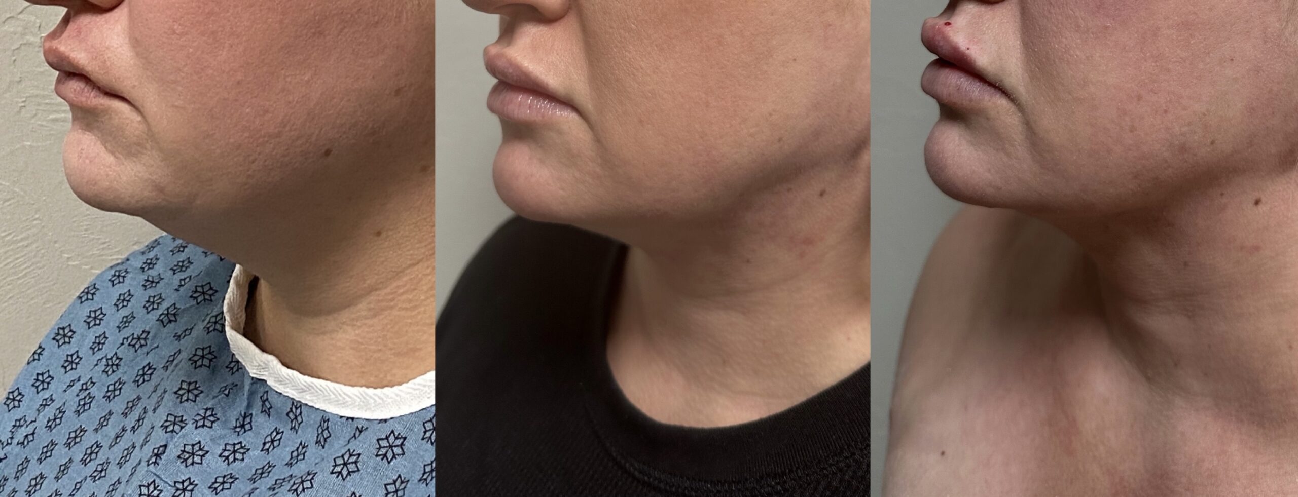 Progressive results on woman's face from FaceTite procedure.