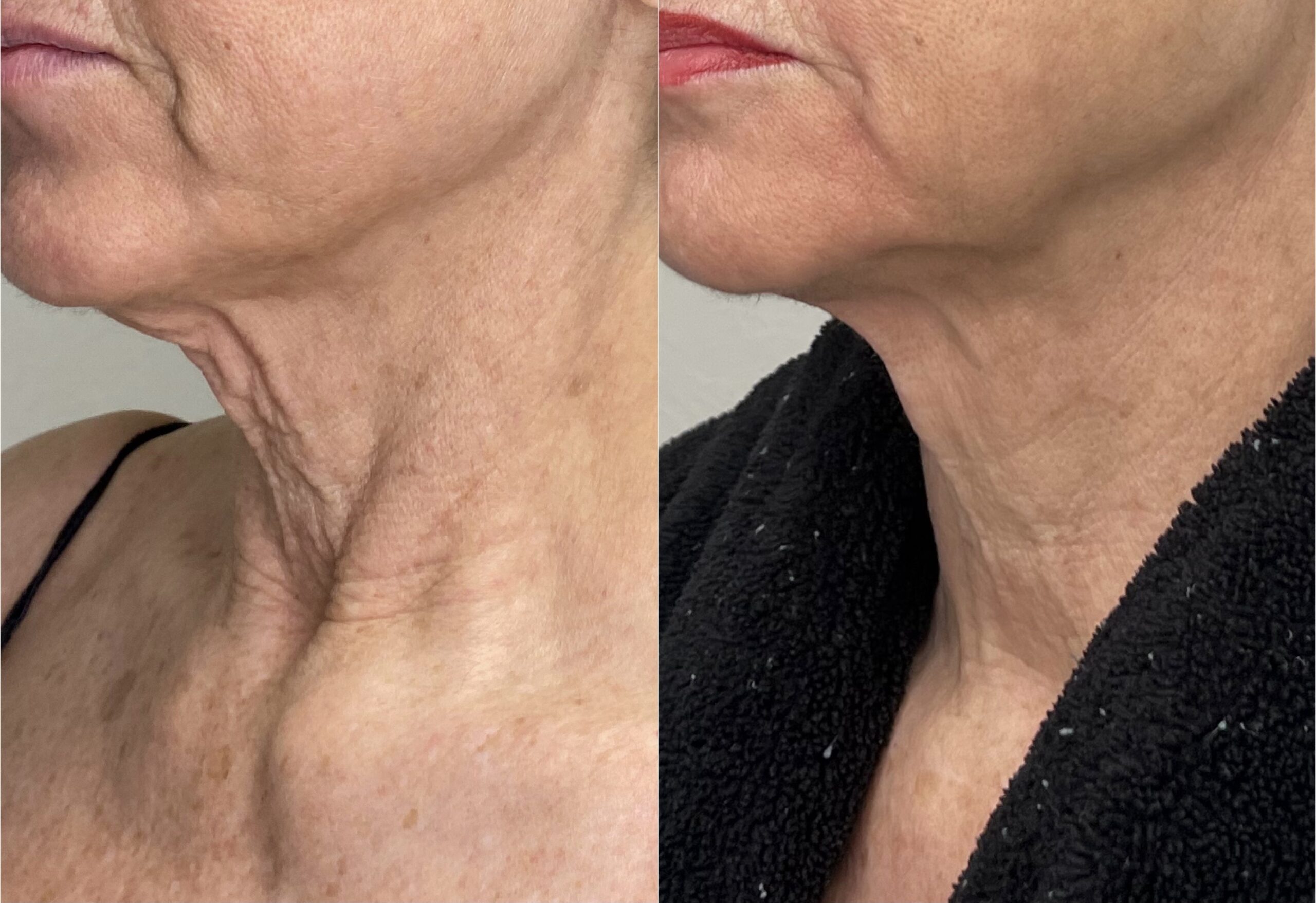 FaceTite procedure results at Contour Oklahoma.
