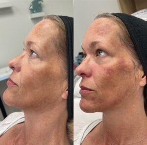 Alternate view of woman after receiving IPL treatment from Contour Oklahoma in Edmond.