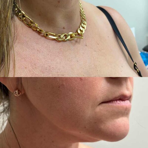 Woman showing before/after of FaceTite procedure with Contour Oklahoma in Edmond.