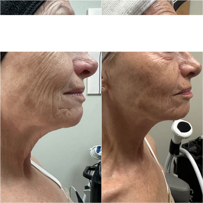 Before and after facial skin tightening with Morpheus8 from Contour Oklahoma.