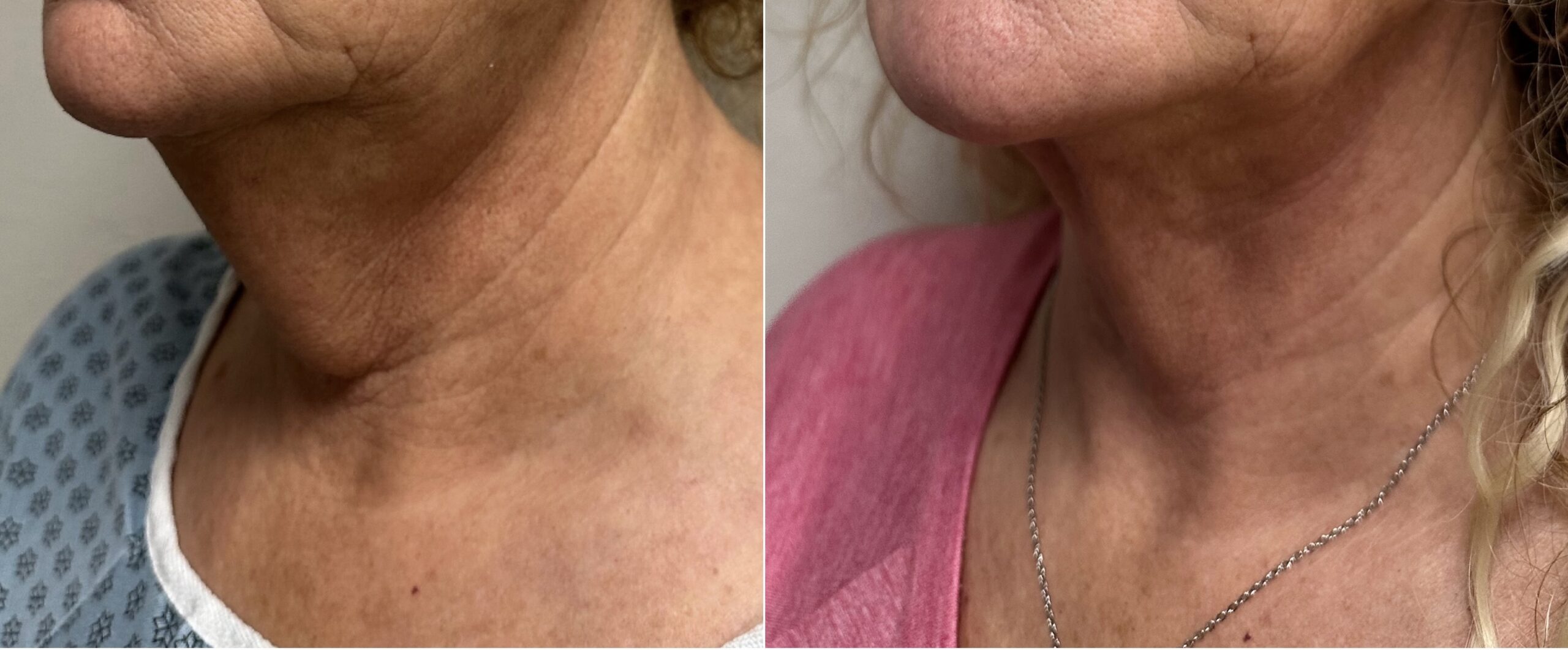 Before and after FaceTite for woman wearing a pink t-shirt.