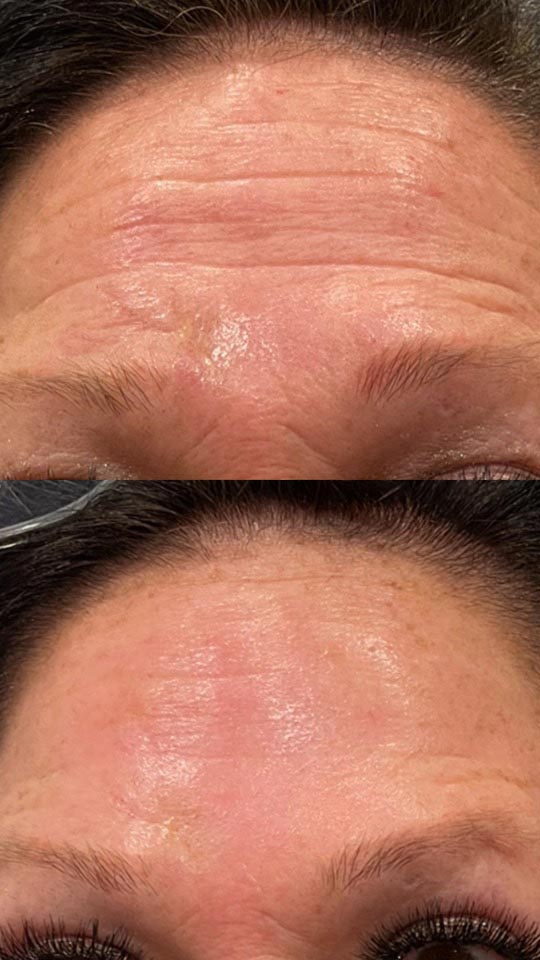 Woman's forehead after Botox treatment at Contour Oklahoma.