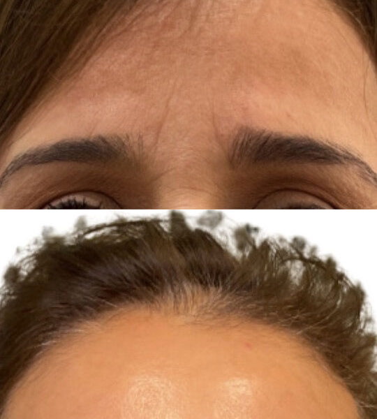 Improvement in forehead wrinkles on woman after Injectable treatment from Contour Oklahoma of Edmond.
