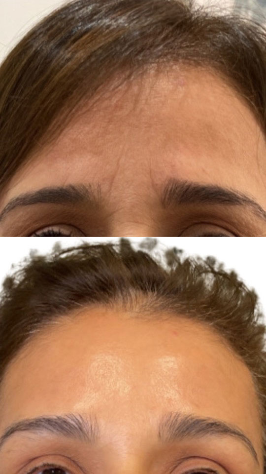 Improvement in forehead wrinkles on woman after Injectable treatment from Contour Oklahoma of Edmond.