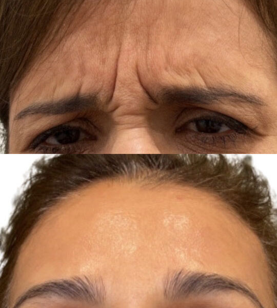 Alternate view of improvement in forehead wrinkles on woman after Injectable treatment from Contour Oklahoma of Edmond.