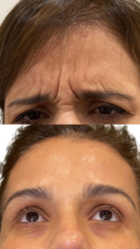 Alternate view of improvement in forehead wrinkles on woman after Injectable treatment from Contour Oklahoma of Edmond.