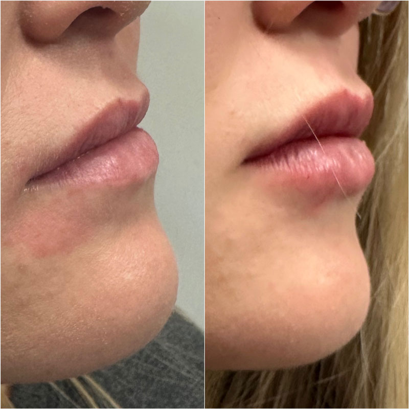 lip
