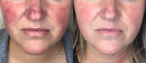 Woman's redness in cheeks diminished after IPL treatment from Contour Oklahoma.