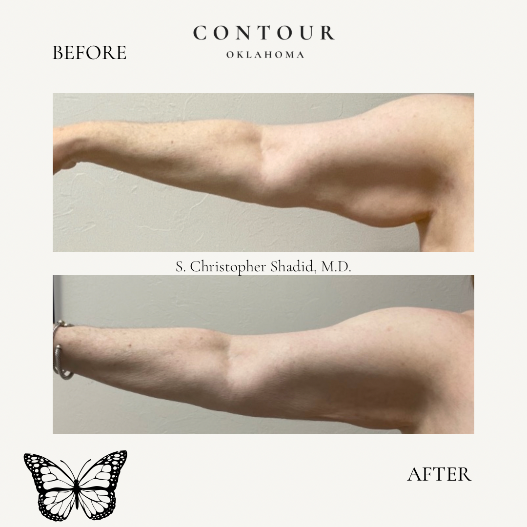 Before After BodyTite 01