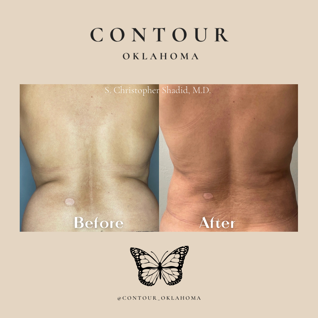 Before After BodyTite 02