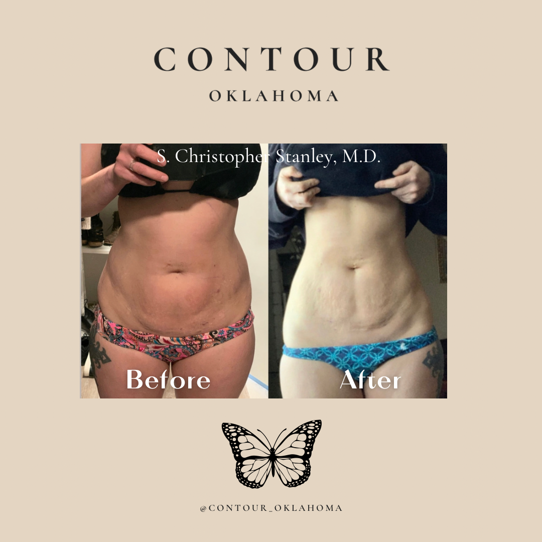 Before After BodyTite 03