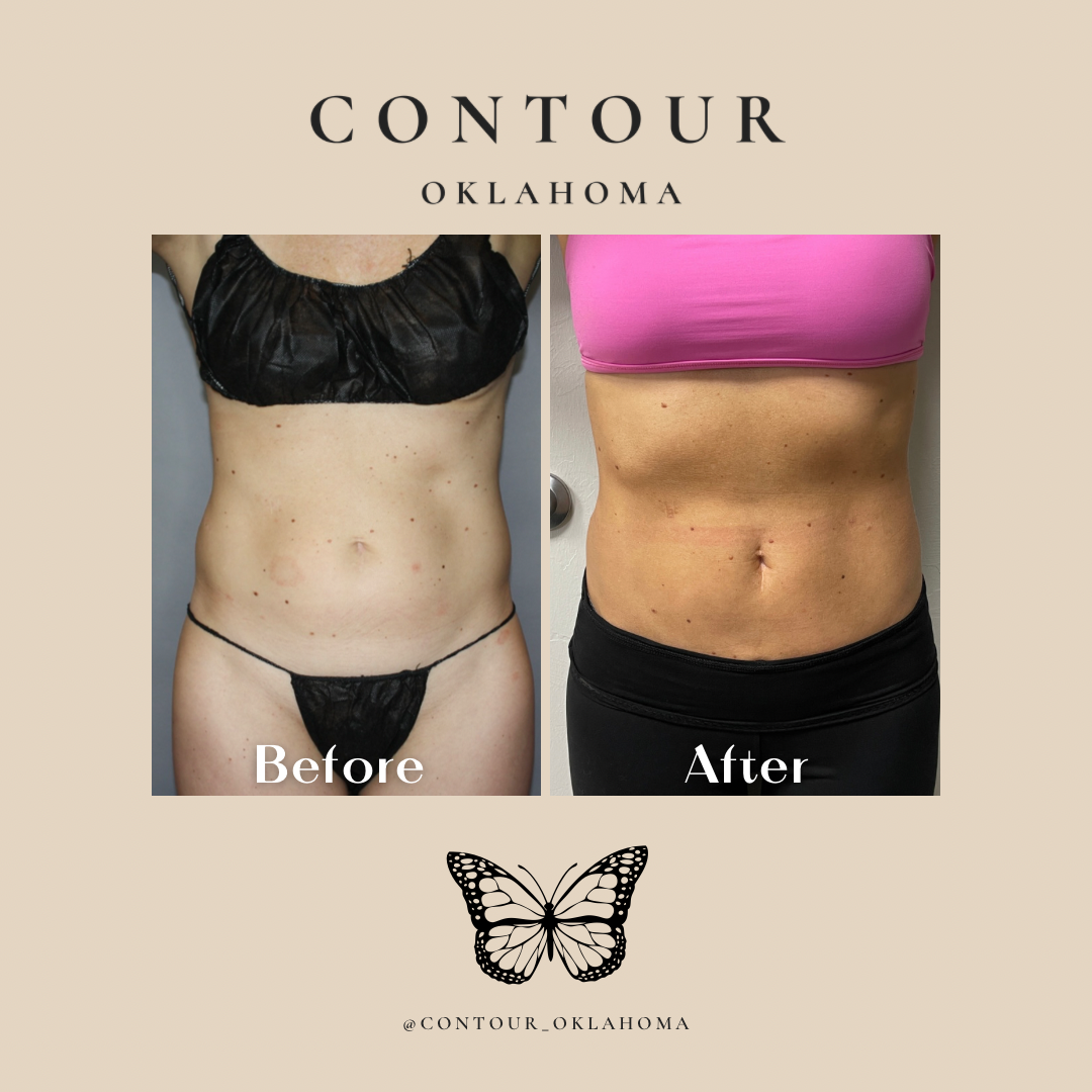 Before After BodyTite 04