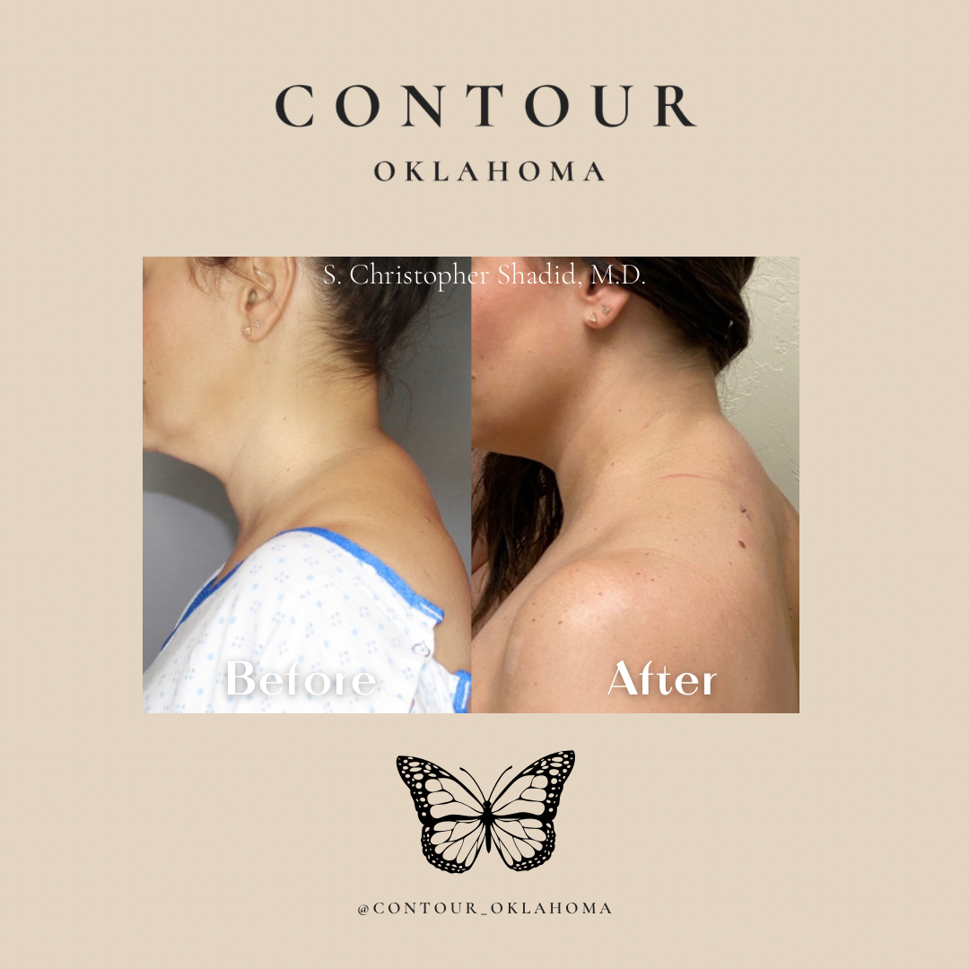 Before After BodyTite 05