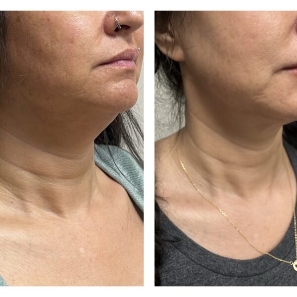 FaceTite Before After 01