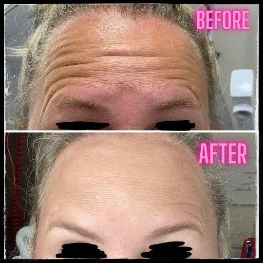 Before and after Botox injections at Contour Oklahoma.
