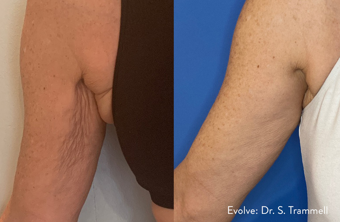 evolve-before-after-02